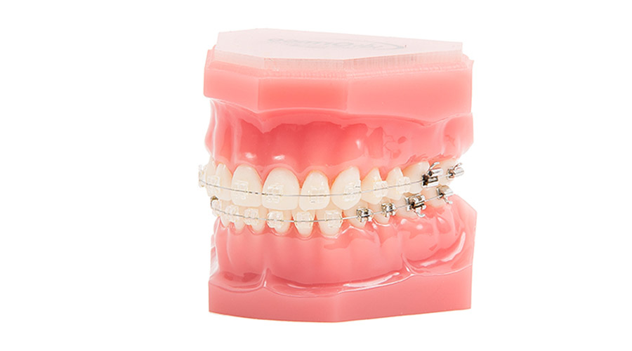 Keramikbrackets